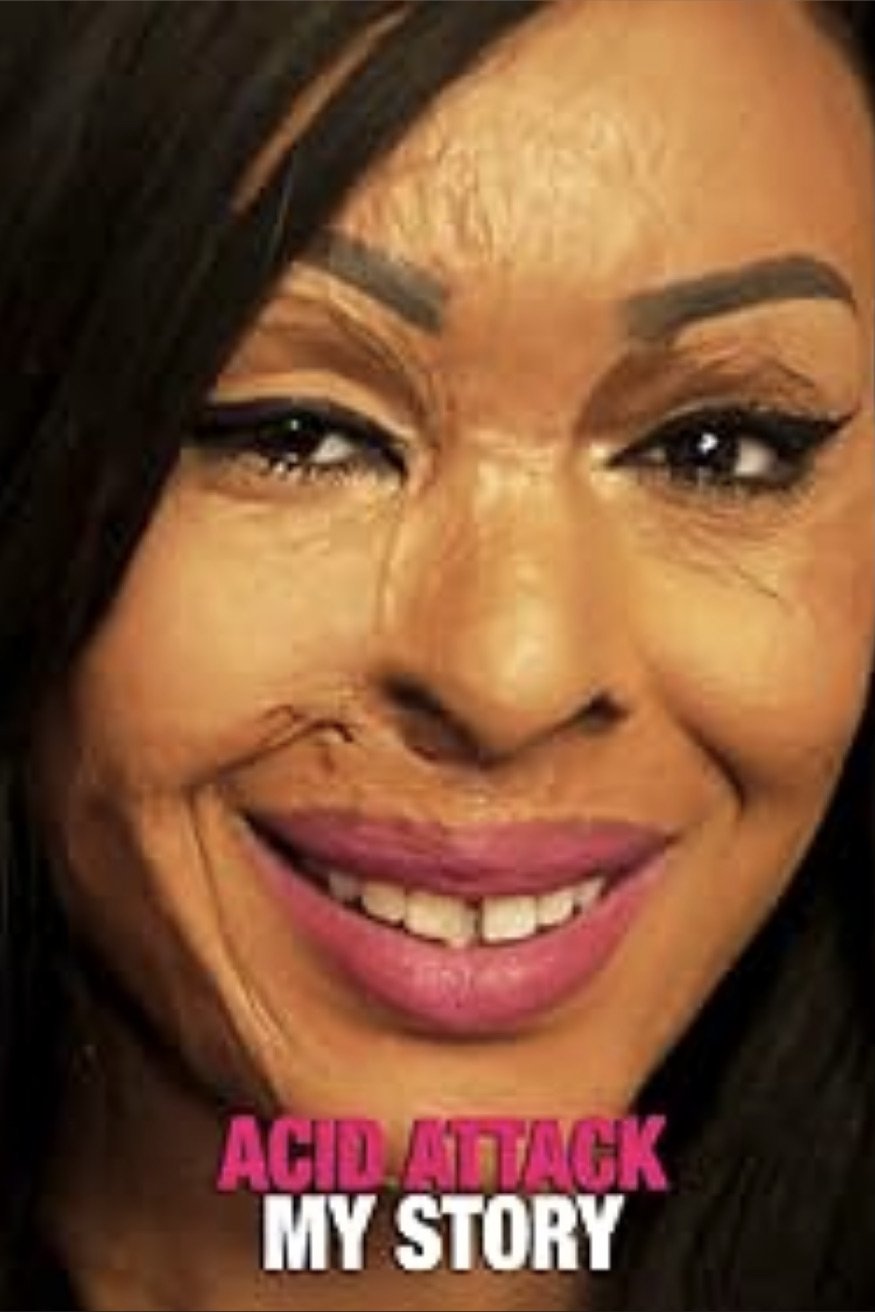 Acid Attack: My Story - Bild 1 von 3